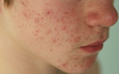 Mùa Đông trên da mặt xuất hiện nhiều mụn li ti, điều trị thế nào?