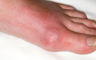 Bị đau nhức bàn chân, khó đi lại, có phải bị bệnh gout không?