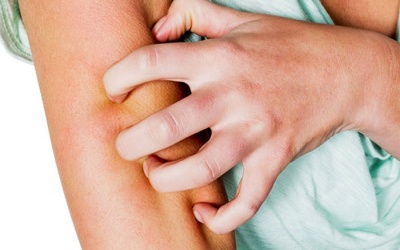 Bị suy thận, lọc máu định kỳ và da ngứa ran, làm thế nào để giảm ngứa?