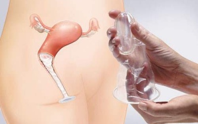 Các biện pháp tránh thai dành cho nữ