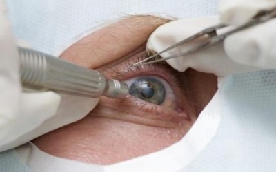 Đái tháo đường làm tăng gấp đôi nguy cơ đục thủy tinh thể 