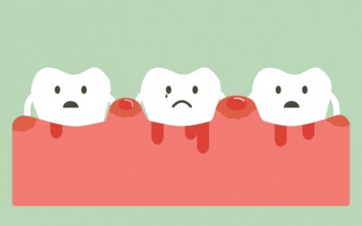 9 dấu hiệu 'chỉ điểm' bạn đang bị viêm lợi hay nha chu