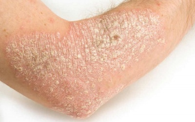 Bị bệnh vảy nến, liệu pháp điều trị nào có thể giúp tôi khỏi hoàn toàn?