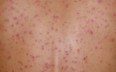 Bị mụn cá ở lưng, chữa trị thế nào?