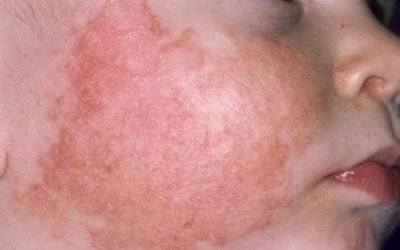 Mặt con tôi có mảng da sần, ngứa, có nên tắm nước lá cho con?