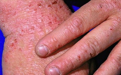Người bệnh eczema nên ăn và tránh thực phẩm nào?