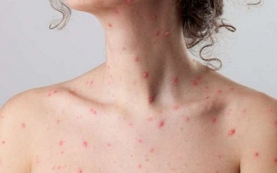 Biến chứng thủy đậu ở người lớn: Không cẩn thận dễ tử vong!