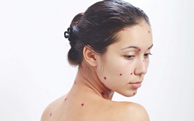 Những triệu chứng thủy đậu thường gặp ở người lớn