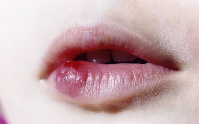 Sưng môi, ngứa môi có nên bôi mật ong không?