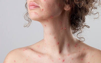 Một vài bài thuốc trị thủy đậu bằng Đông y