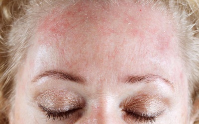 Cách đối phó với 4 vấn đề thường gặp ở da