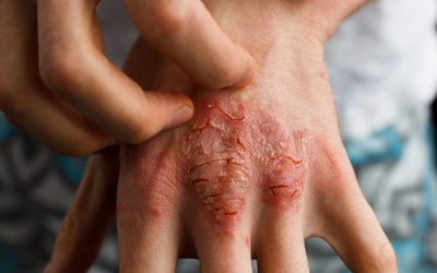 Những loại thuốc có thể làm bệnh vảy nến nặng hơn