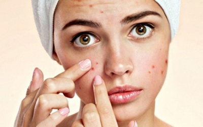 8 lời khuyên của chuyên gia giúp loại bỏ mụn trứng cá