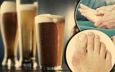Uống bia có làm tăng nguy cơ mắc bệnh gout?