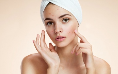 9 quan điểm sai lầm về mụn trứng cá