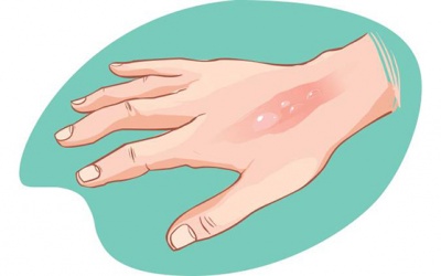 Các loại bỏng thường gặp và các mức độ bỏng bạn nên nắm rõ