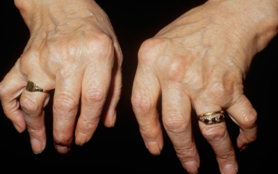 Làm sao để phát hiện sớm viêm khớp dạng thấp?