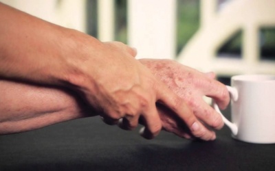 Làm thế nào để chữa trị bệnh Parkinson để đạt hiệu quả tốt?