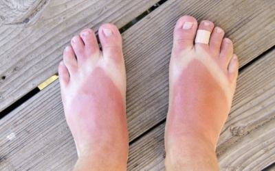 Làm sao để hồi phục làn da bị cháy nắng?