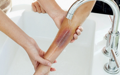 Xử lý bỏng nhẹ do lửa bằng các nguyên liệu sẵn có trong căn bếp