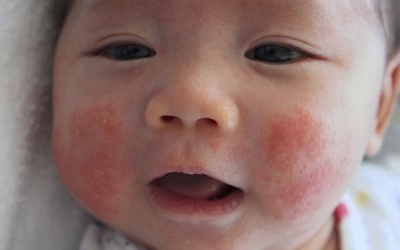 Bệnh eczema ở trẻ: Giải đáp những thắc mắc thường gặp
