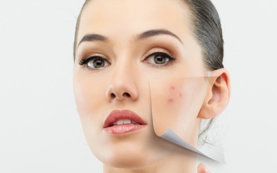 Những điều cần biết về mụn trứng cá ở người trưởng thành