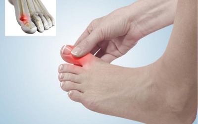 5 phương pháp đơn giản giúp điều trị bệnh gout tại nhà