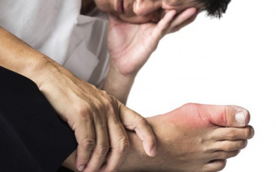 Làm thế nào để phòng ngừa cơn gout cấp tái phát?