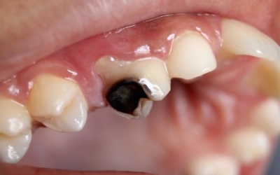 Nguyên nhân nào gây sâu răng?