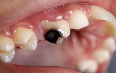 Sâu răng có tự khỏi không?