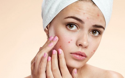 7 loại mụn trứng cá thường gặp và cách xử trí mụn 