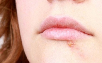 Phụ nữ mang thai bị rộp môi có gây nguy hiểm cho thai nhi?