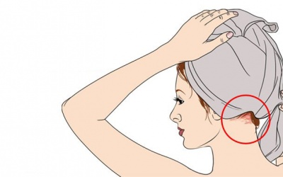 Phiền phức hơn cả gàu, phải trị vảy da đầu thế nào?