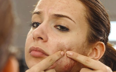 5 cách đơn giản giúp điều trị mụn trứng cá 