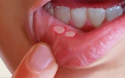 Bị nhiệt miệng chữa thế nào cho nhanh khỏi?