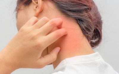 10 lưu ý ăn uống khi bị dị ứng