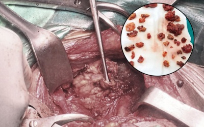 Phát hiện bị ung thư tuyến giáp sau khi xuất hiện nhiều hạch nhỏ ở cổ