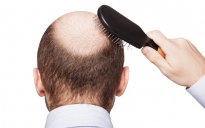 4 loại tinh dầu giúp ngăn ngừa hói đầu hiệu quả