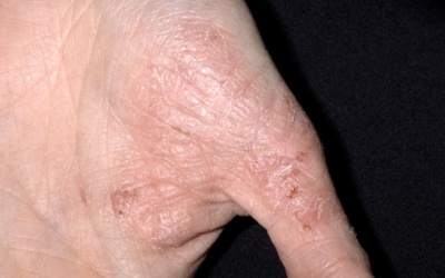 Những biện pháp đơn giản giúp điều trị eczema