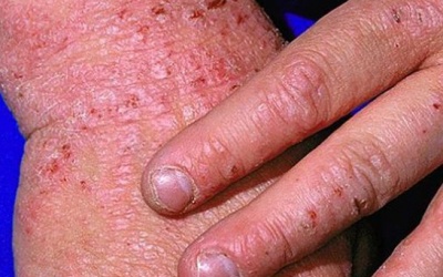 Làm sao để giảm sẹo khi bị eczema?