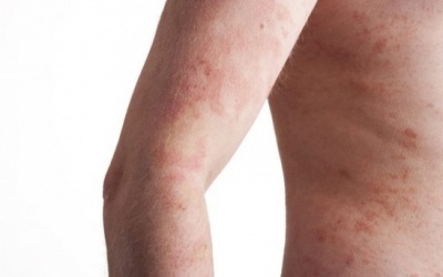 Những biện pháp tự nhiên giúp cải thiện triệu chứng eczema