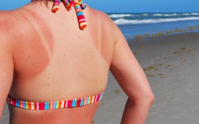 Làm gì khi da bị cháy nắng sau đi biển?