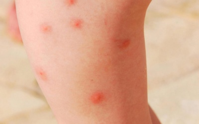 9 cách đơn giản giúp giảm sưng ngứa do muỗi đốt
