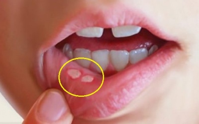 Phân biệt nhiệt miệng và tổn thương khoang miệng