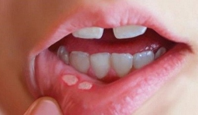 Xử lý nhiệt miệng bằng thảo dược