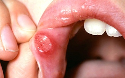 9 bài thuốc Đông y giúp trị nhiệt miệng hiệu quả