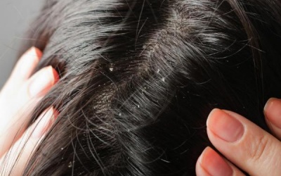 Cách trị gàu đơn giản bằng dầu dừa
