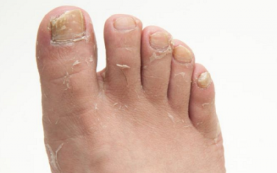 Bài thuốc dân gian trị nấm bàn chân