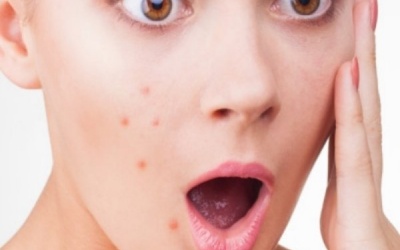 Làm mờ đốm nâu, đồi mồi trên da bằng các biện pháp tự nhiên
