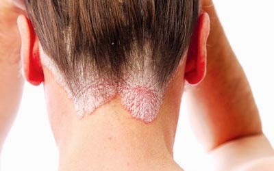 Làm thế nào để điều trị bệnh vẩy nến da đầu?